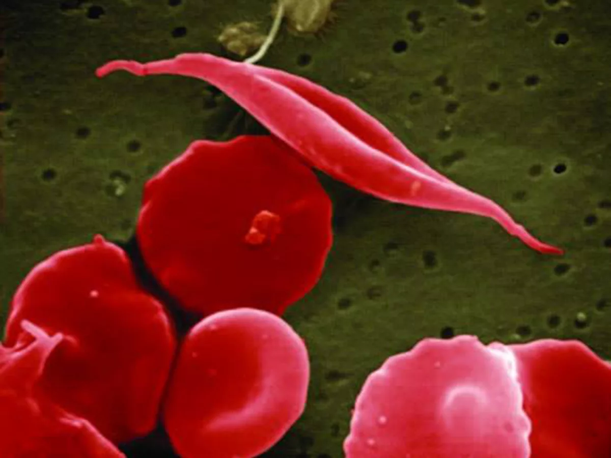 Sickle cell disease Sickle cell disease