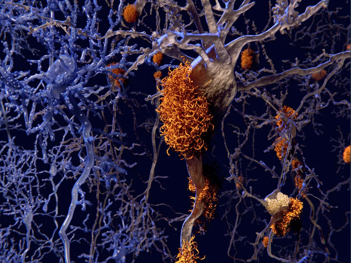 Tau neuron illustration Tau neuron illustration