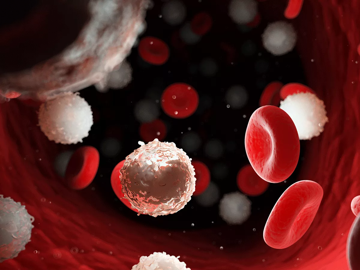 Leukemia illustration Leukemia illustration