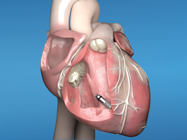 Medtronic micra av in heart illustration