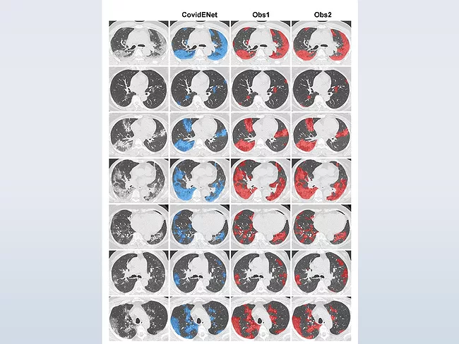 Software analysis of chest CT scans