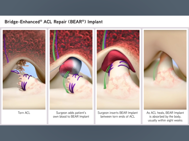 Illustration showing the Bridge-Enhanced ACL Repair (BEAR) implant process