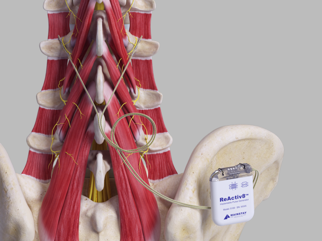 Reactiv8 device on spine model