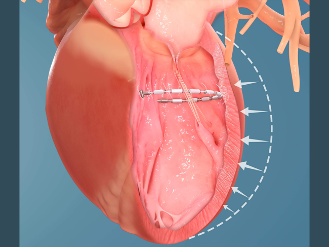 Accucinch in heart model