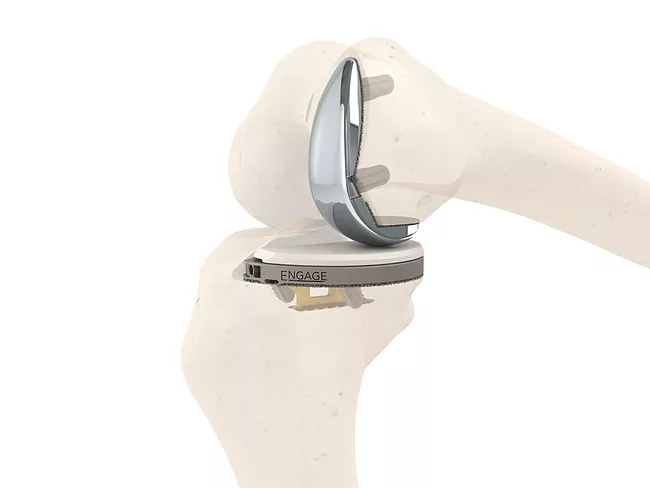 Knee implant in skeleton model