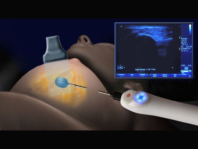 Illustration of cryoblation procedure in breast