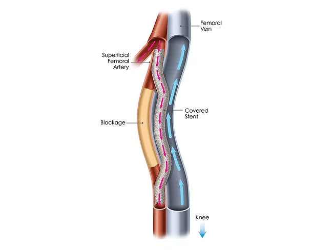 Illustration of Detour system in femoral artery/vein
