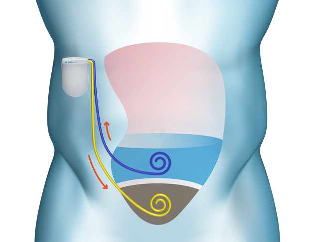 Illustration of device in body