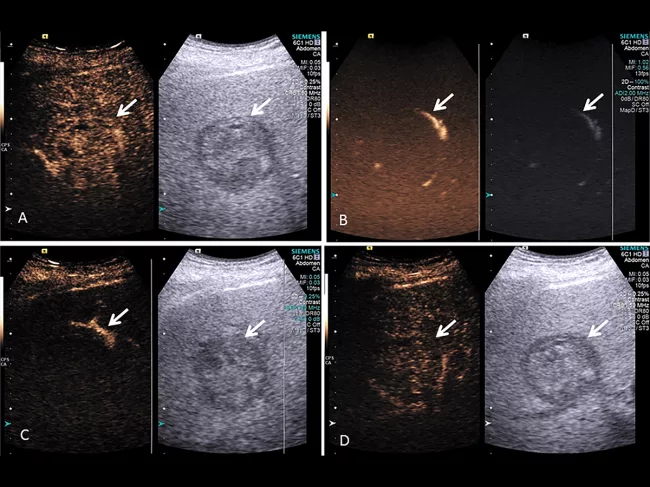 HCC response to TARE