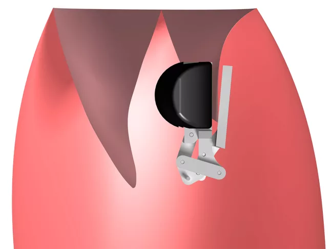 Heart, implant illustration