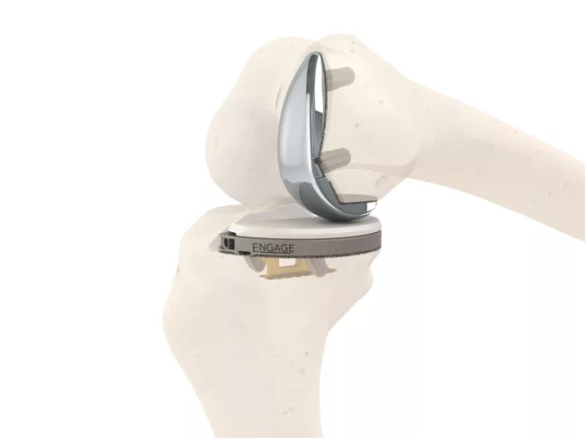 Knee implant in skeleton model