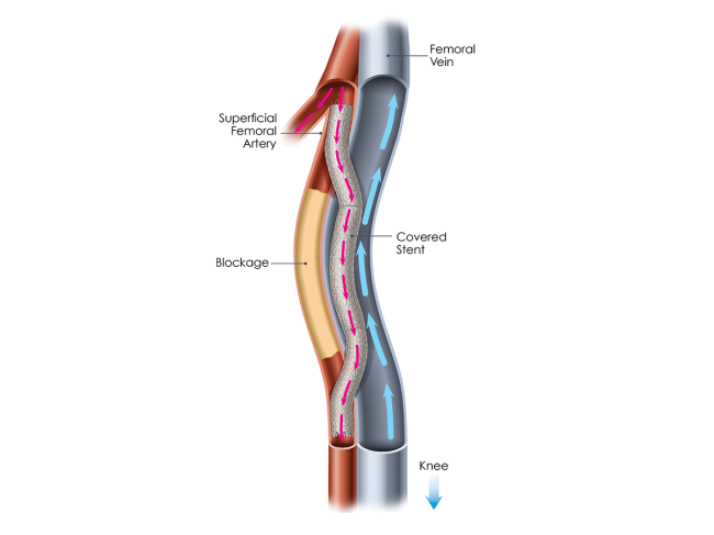 Illustration of Detour system in femoral artery/vein