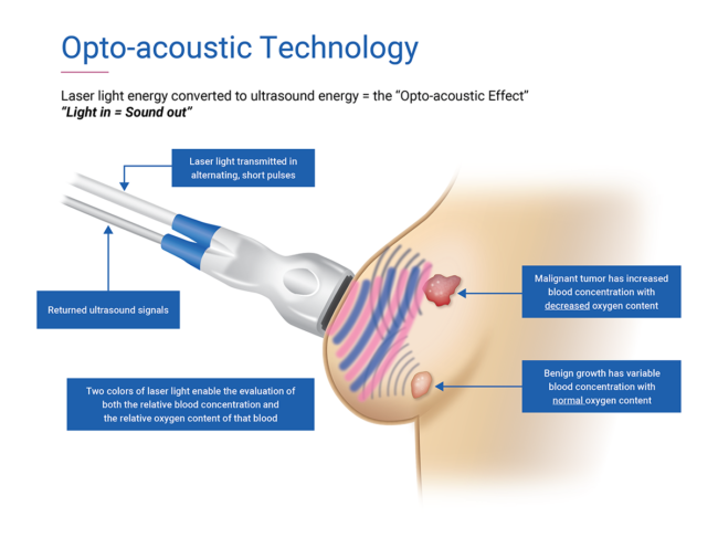 Illustration showing how opto-acoustic technology detects breast cancer