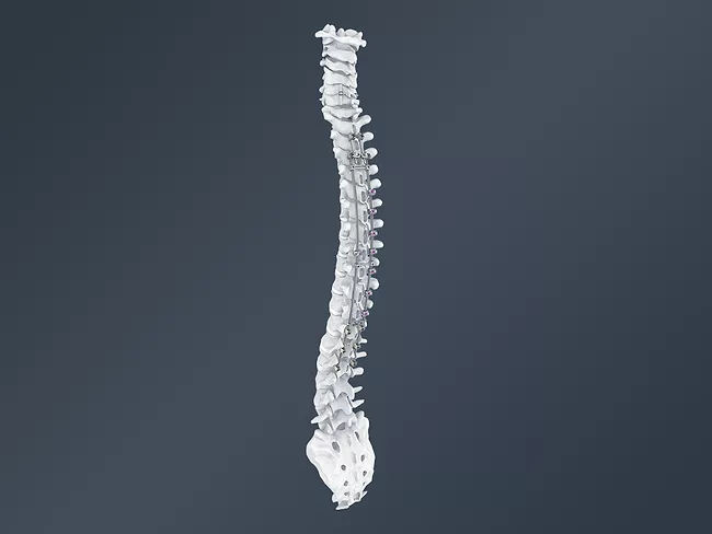 Jazz implants on spine