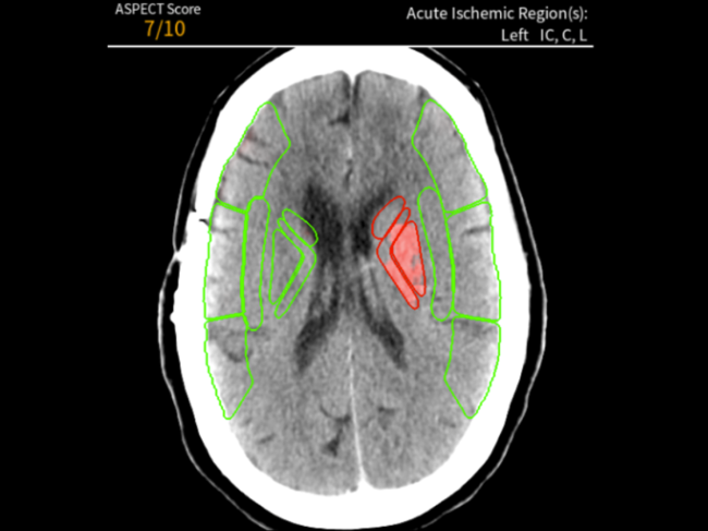 Brain scan image from Cina Aspects software
