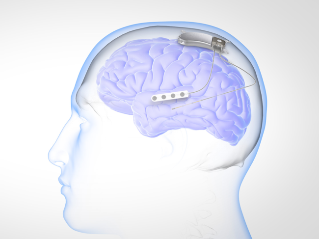 Illustration of RNS system placement in brain