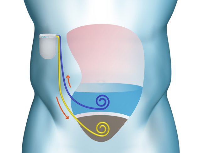 Illustration of Alfapump in body