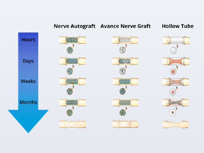 Illustration of Avance nerve graft over time vs. nerve autograft and hollow tube