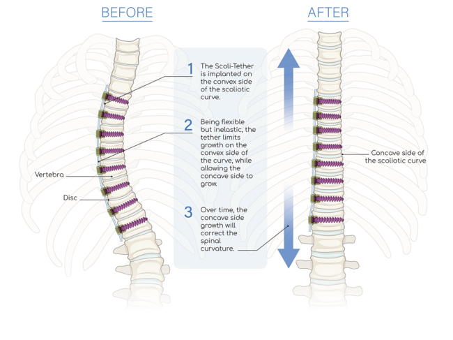 Illustration of spine before and after Miscoli