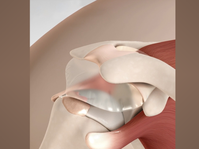 3D illustration of shoulder with Inspace implant