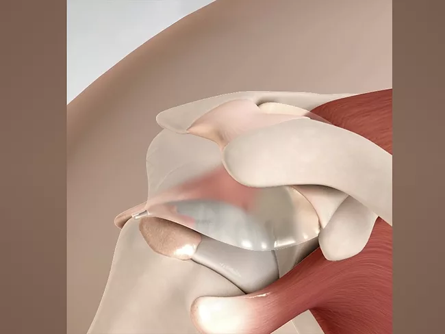 3D illustration of shoulder with Inspace implant