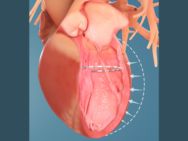 Illustration of Accucinch in heart