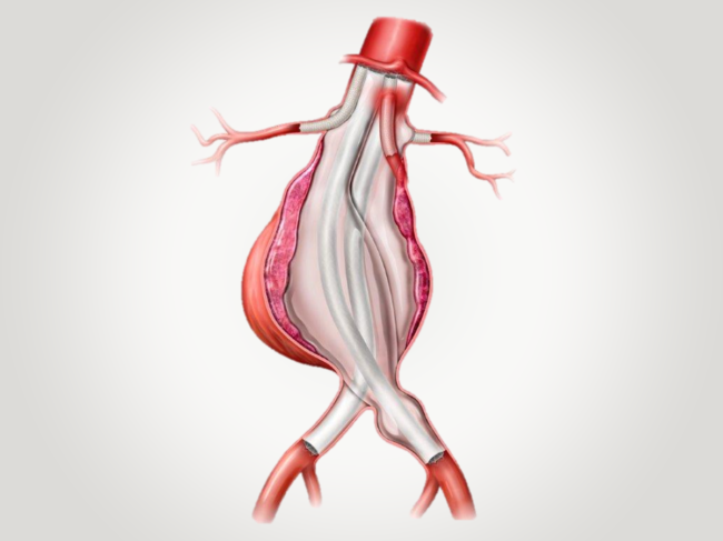 Illustration of ChEVAS in abdominal aortic aneurysm