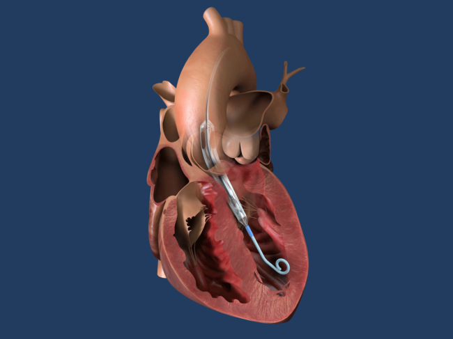 3D illustration of Impella ECP in the heart