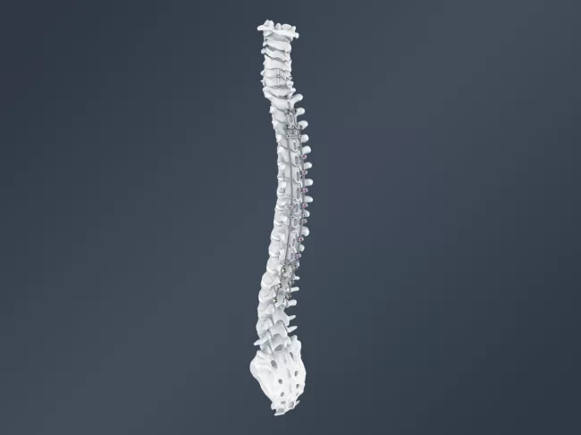 Jazz implants on spine