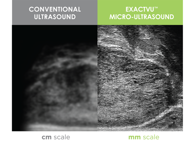 Image quality comparing conventional ultrasound and micro ultrasound
