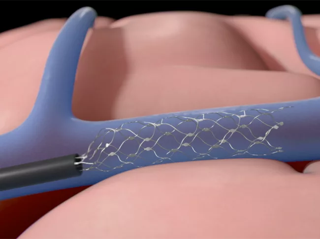 Illustration of Stentrode in brain