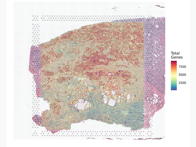 Prostate cancer tissue section overlaid with data from the Visium Spatial Gene Expression for FFPE