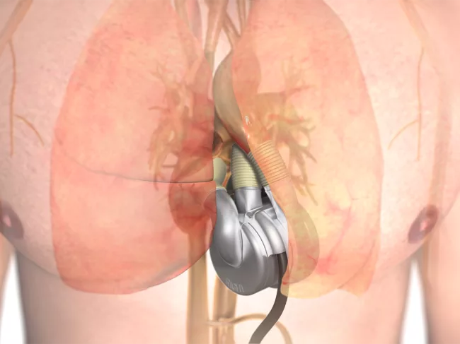 3D illustration of Bivacor implanted in chest