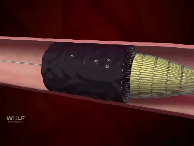 3D illustration of Wolf device in use