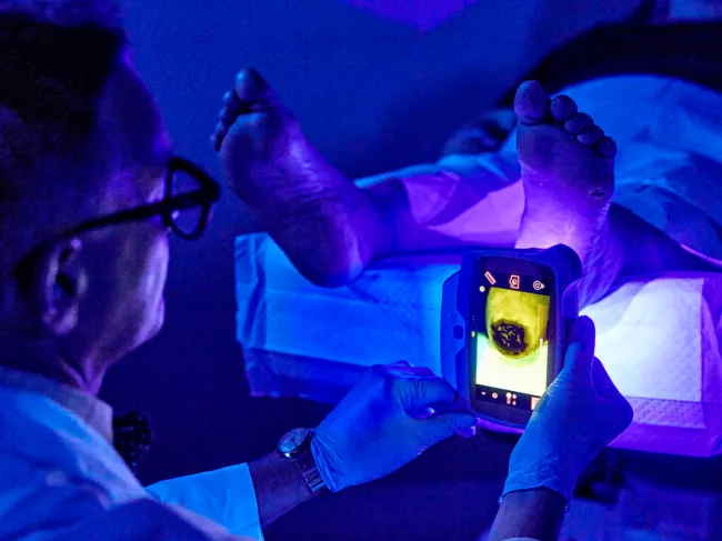 Doctor using Moleculight DX on foot wound