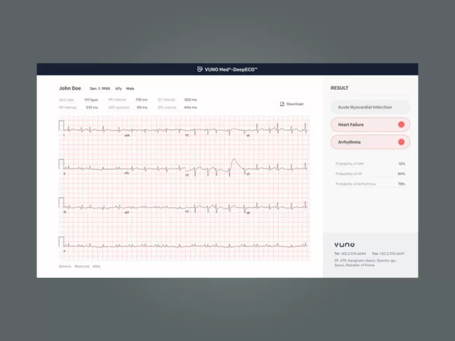 Screenshot of DeepECG software