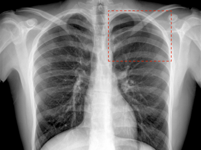 X-ray of chest showing fracture detected by AI