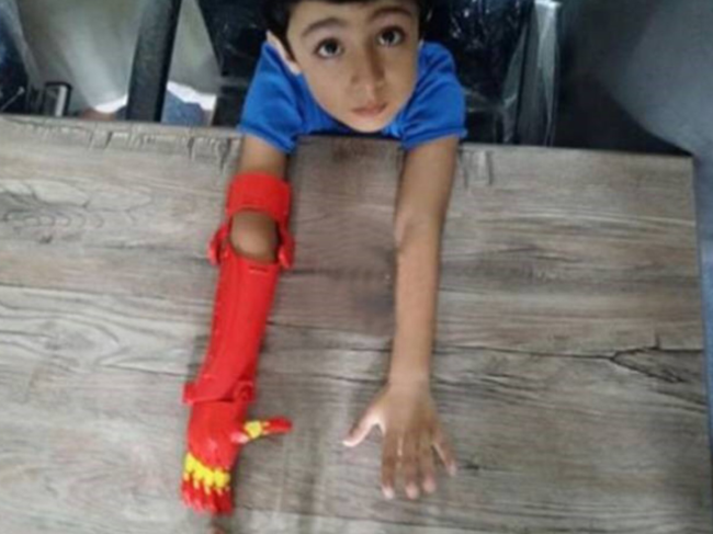 Young boy with Bioniks prosthetic arm