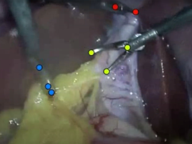 Screenshot of surgical video demonstrating Rsip Vision's virtual measurement technology
