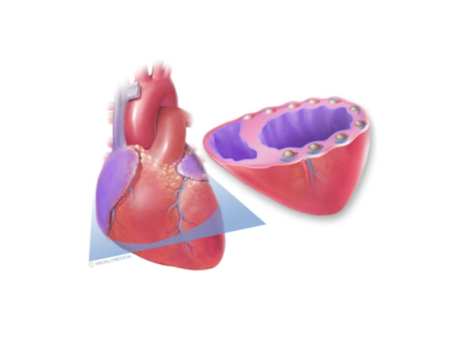 Illustration of hydrogel in heart