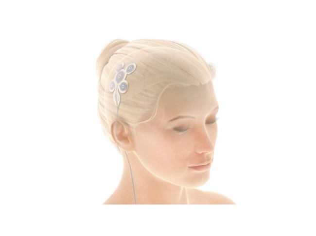 Illustration of Easee electrodes in woman's head