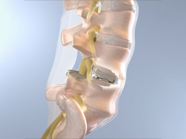 Illustration of the Balancedback total joint replacement device in the spine