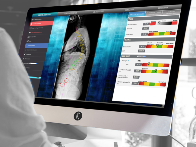 Spine analysis software on desktop monitor