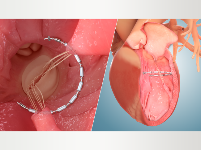 Accucinch device placed in 3D heart model