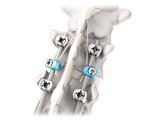 10-27-Jazz-implants---Implanet