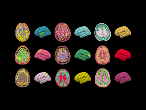 Brain anomalies identified by the MELD AI algorithm