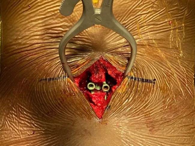 Intra-op image of incision with the inserted Inspan ISP device