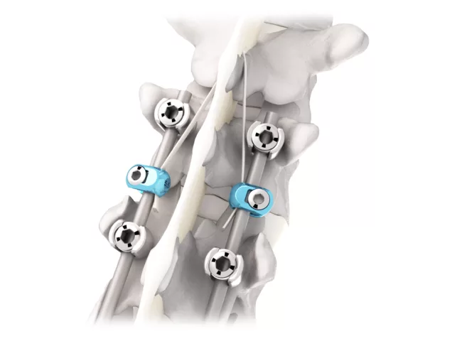 Jazz implants - Implanet