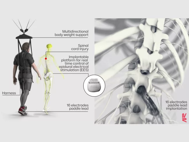 NeuroRestore Vsx wireless implantable pulse generator operating in closed loop