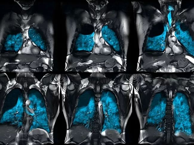 Xenoview in lungs in MRI